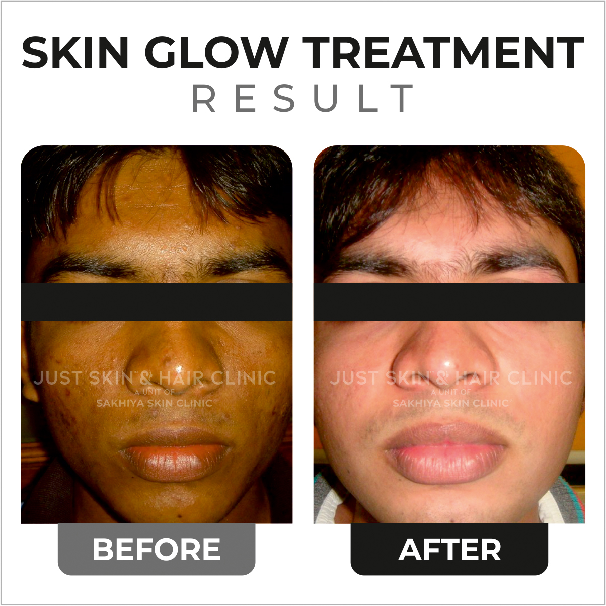 Skin Glow Treatment Before and After Result (3)