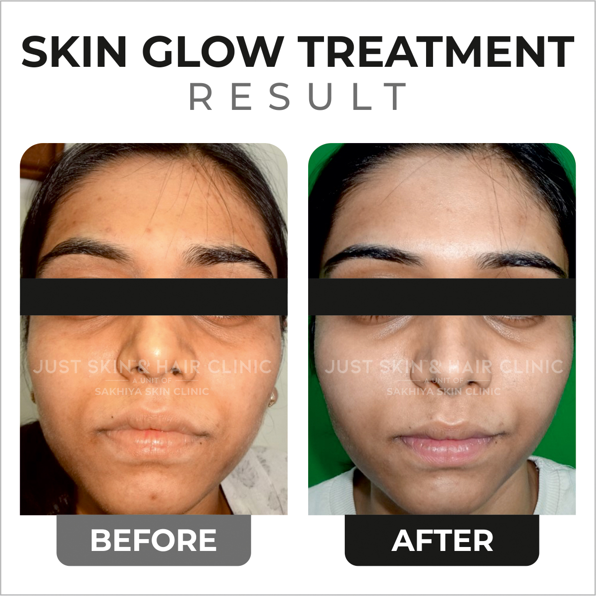 Skin Glow Treatment Before and After Result (4)