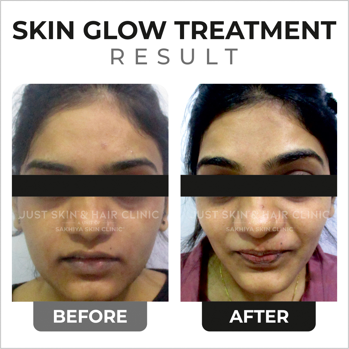 Skin Glow Treatment Before and After Result (5)