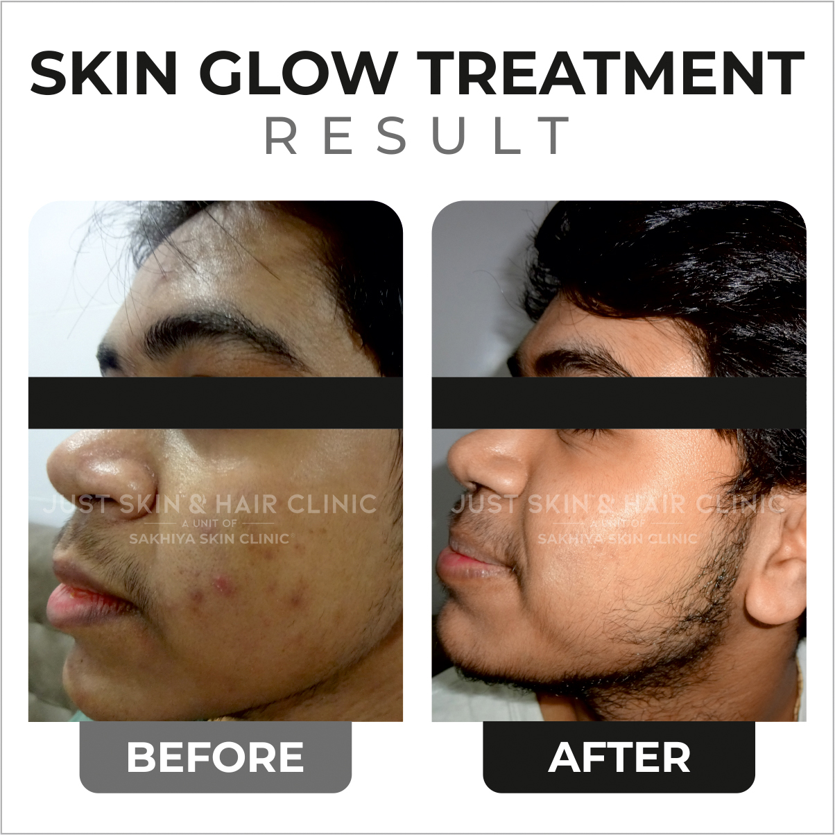 Skin Glow Treatment Before and After Result (6)