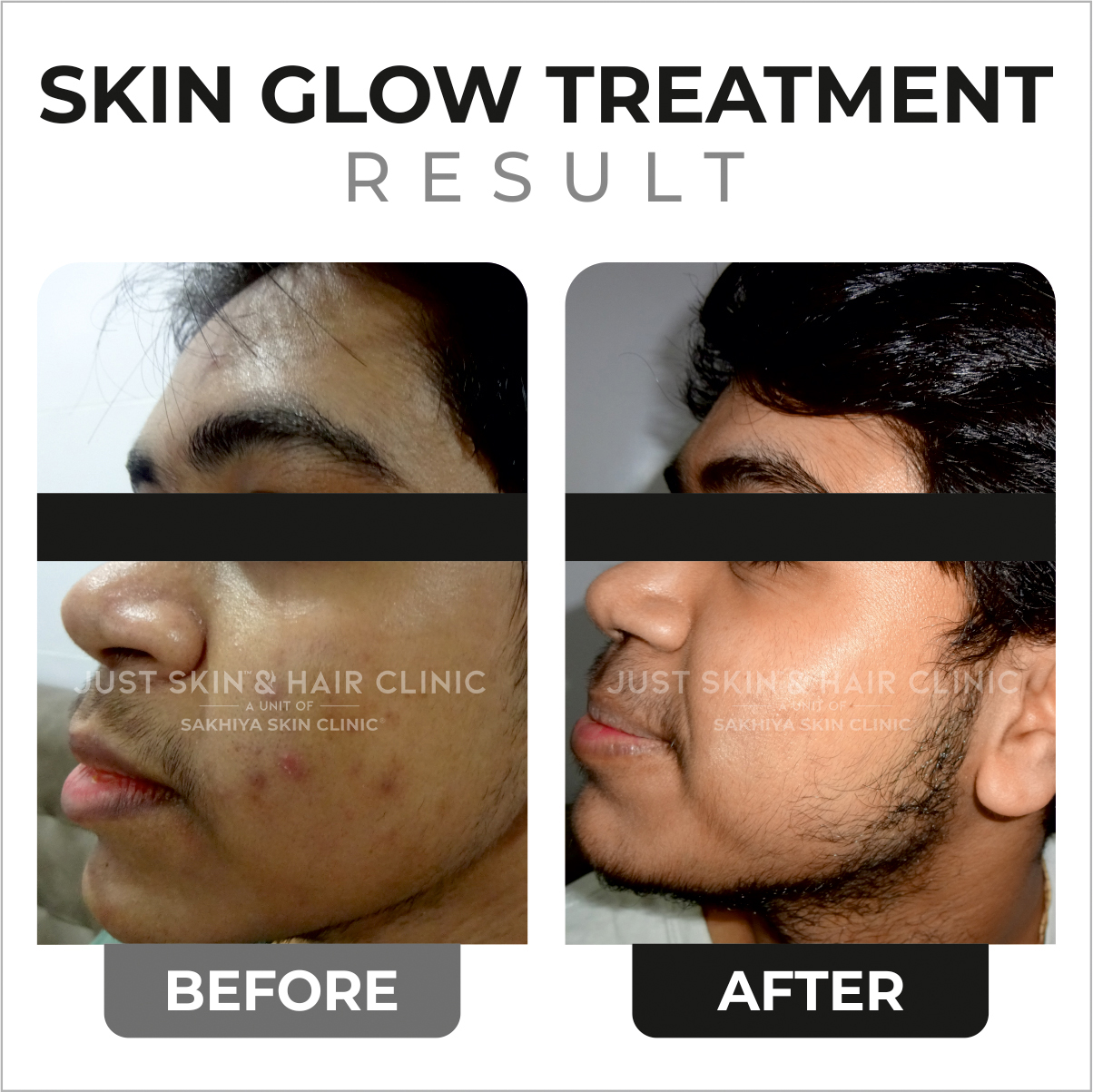 Skin Glow Treatment Before and After Result at Just Skin & Hair Clinic (2)