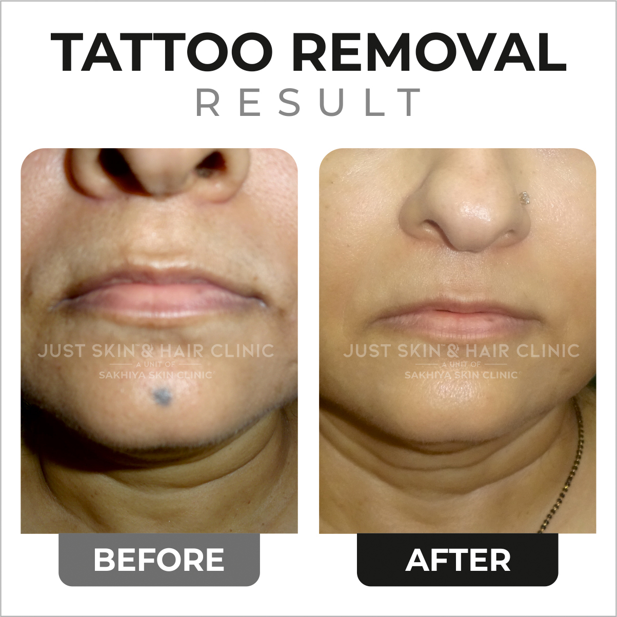 Tattoo Removal Treatment Before and After Result at Just Skin & Hair Clinic (1)