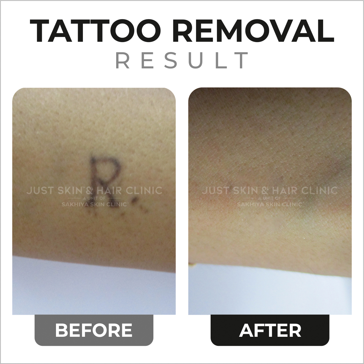 Tattoo Removal Treatment Before and After Result at Just Skin & Hair Clinic (2)