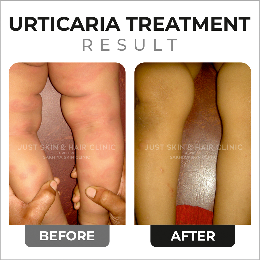 Urticaria Treatment Before and After Result at Just Skin & Hair Clinic (1)