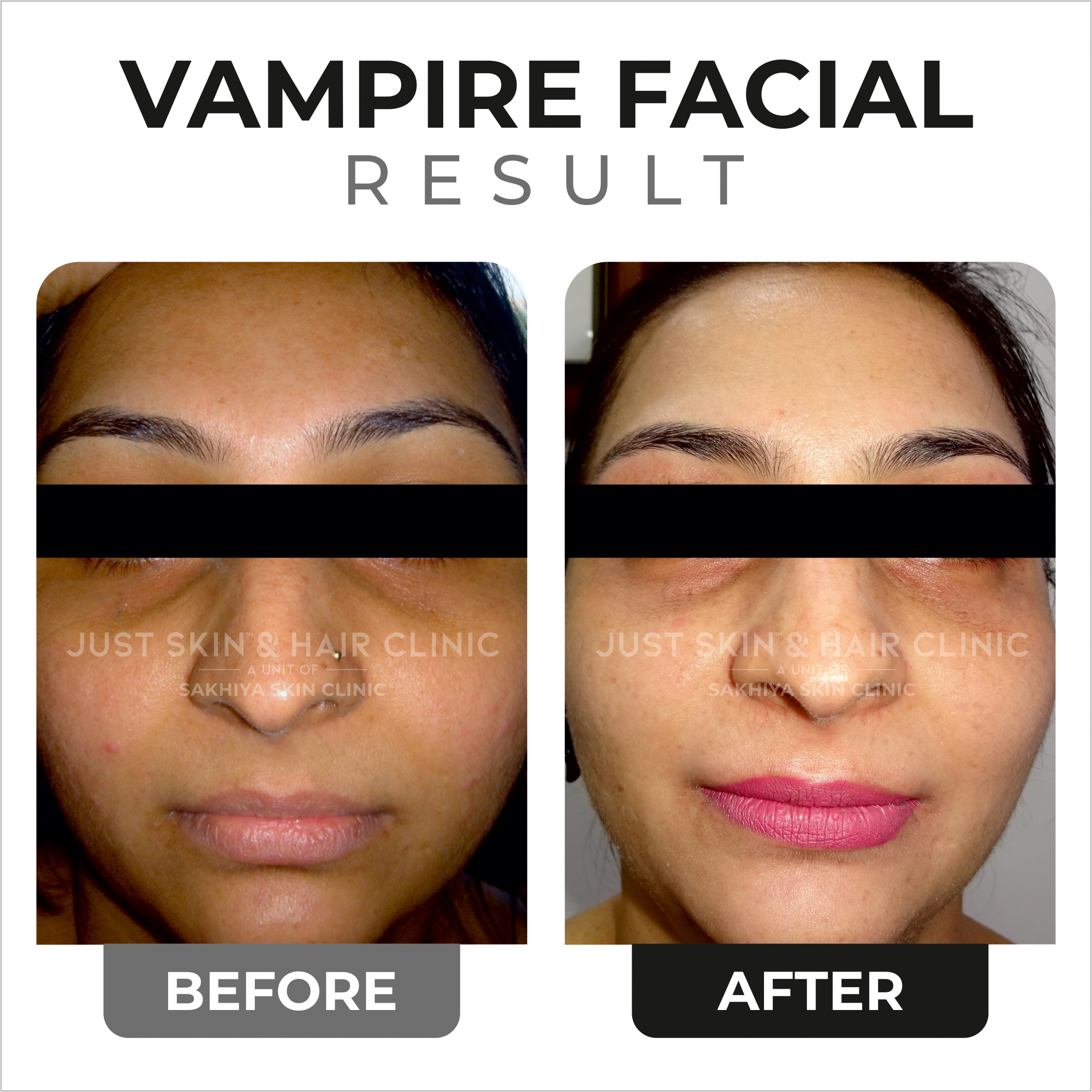 Vampire Facial