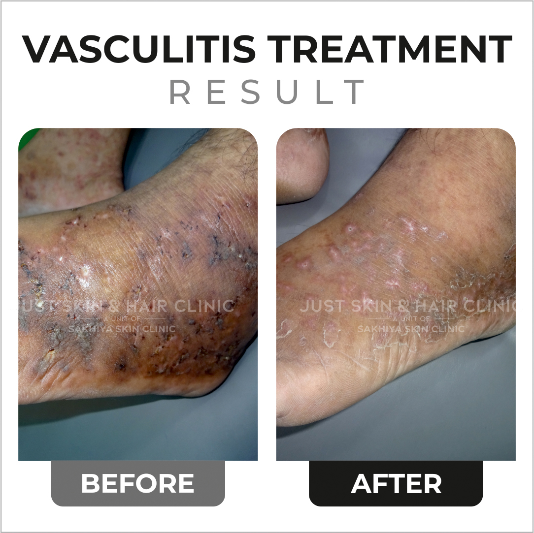 Vasculitis Treatment Before and After Result at Just Skin & Hair Clinic (1)