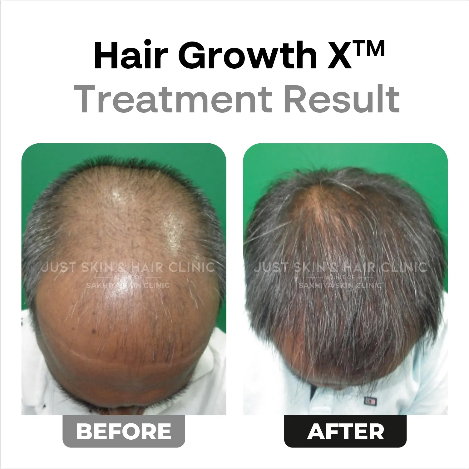HairgrowthX-Treatment-Before-and-After-Result
