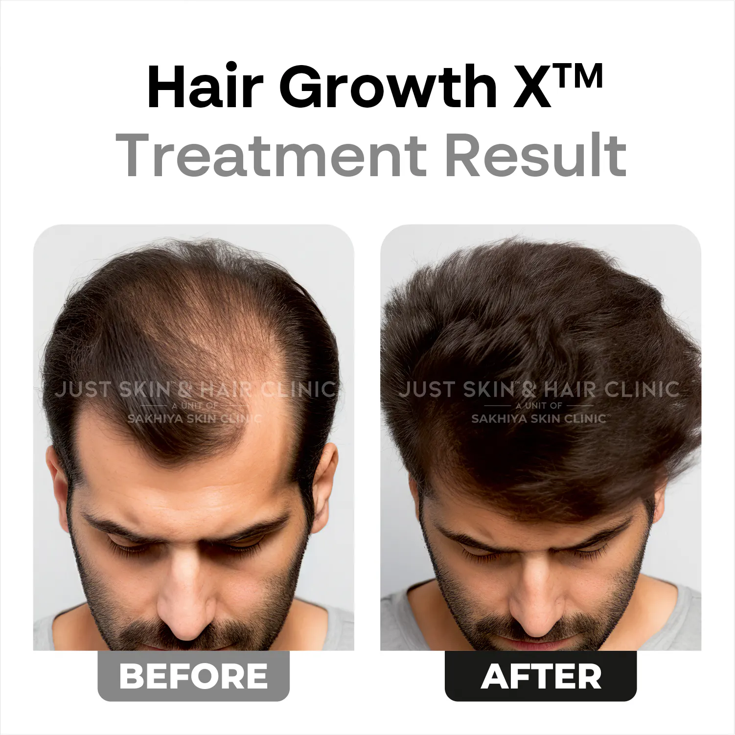 HairgrowthX-Treatment-Before-and-After-Result