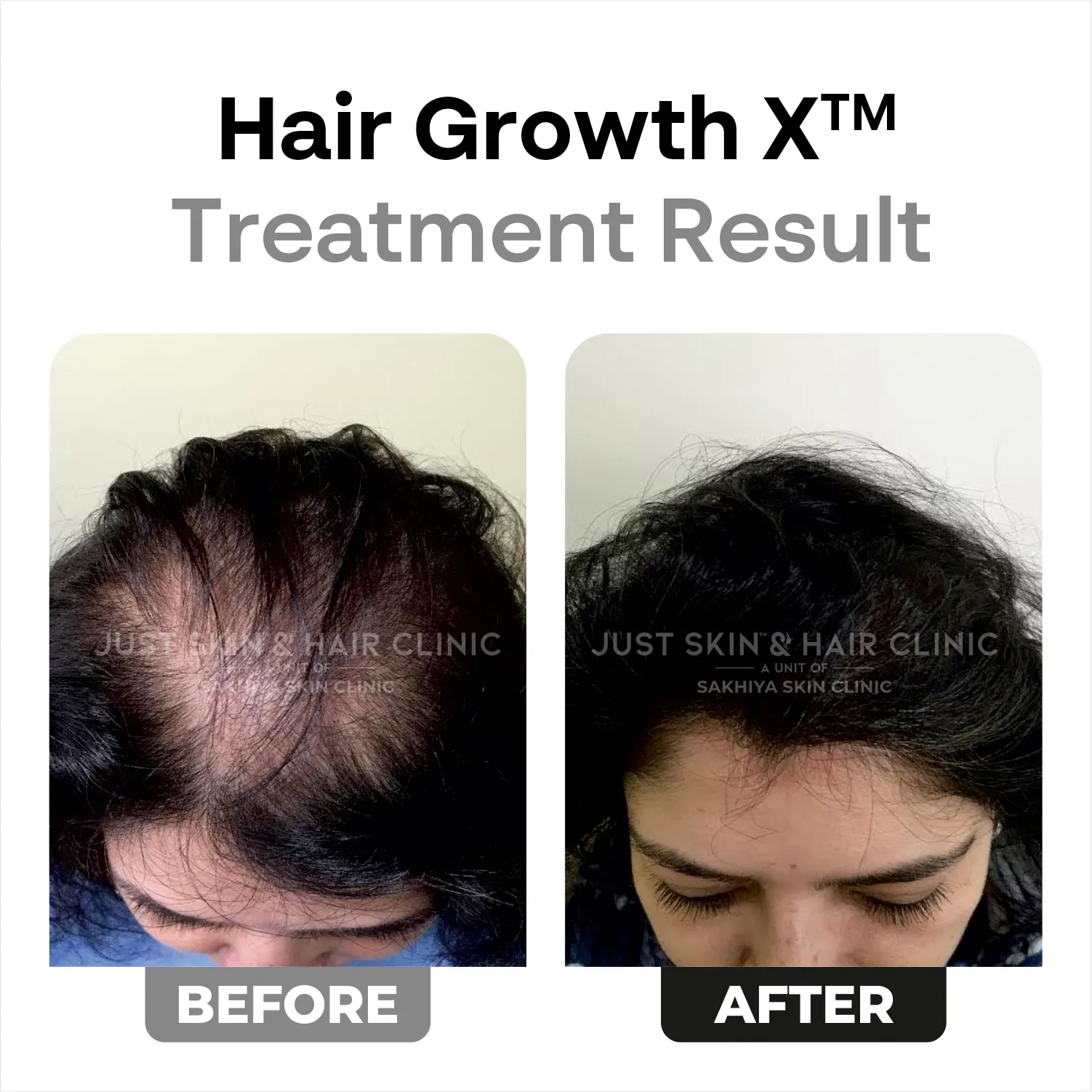 HairgrowthX-Treatment-Before-and-After-Result-3